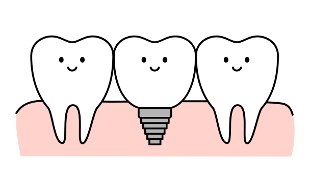インプラントのイラスト