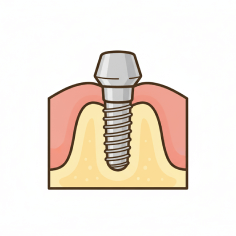 インプラント埋入手術のイラストイメージ