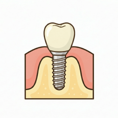 人工の歯の装着のイラストイメージ